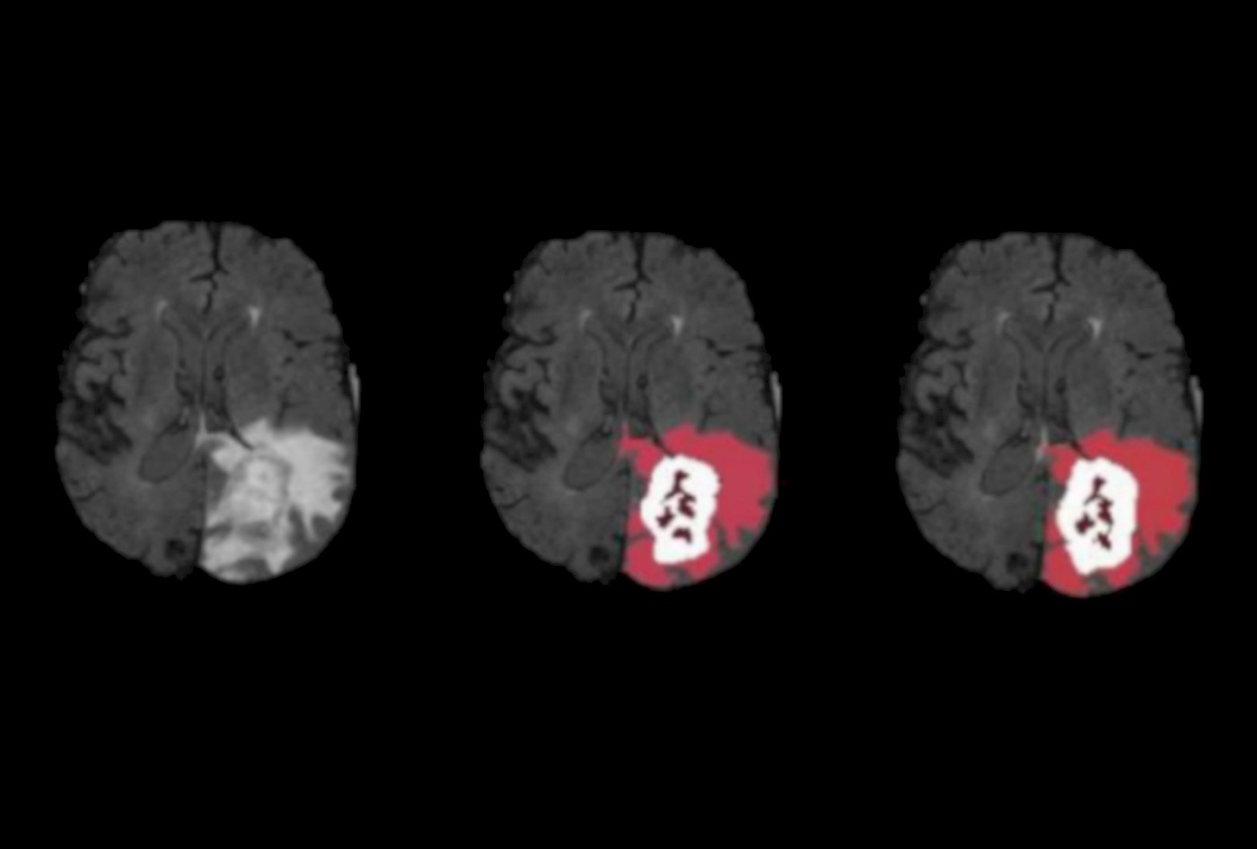 Survival Predictions for Glioma Patients