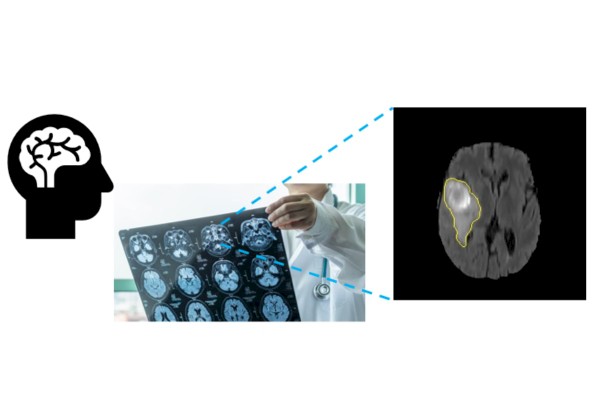 <p>AI Tool Challenges Biopsy to Target Brain Tumour</p>