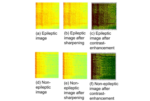 <p>AI-assisted Model for Early Epilepsy Detection</p>