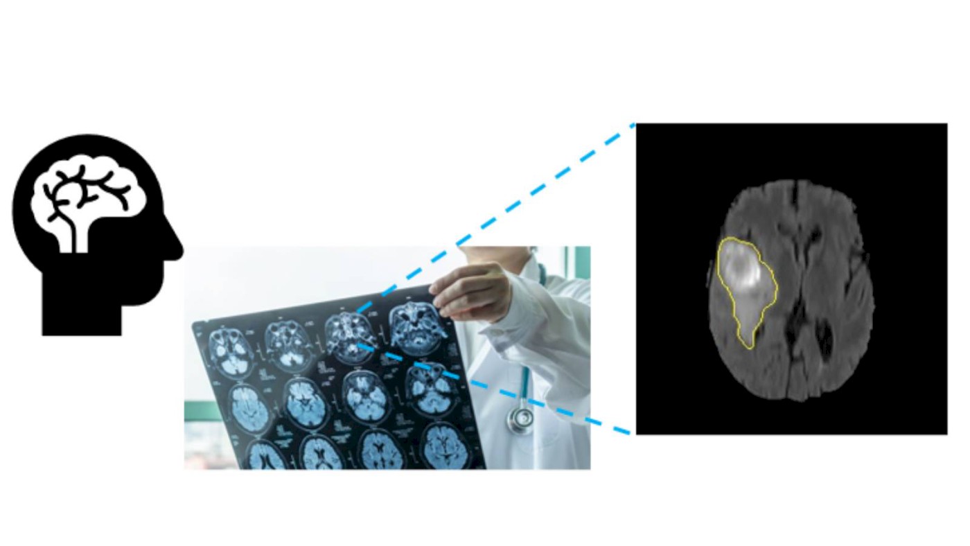 Brain Tumour