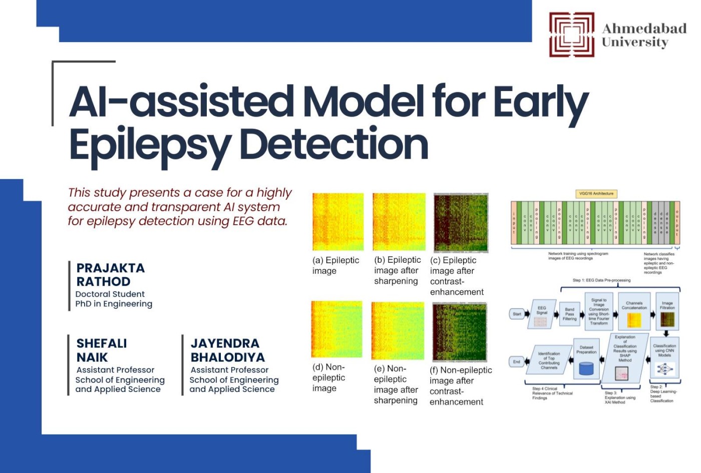 AI-assisted Model for Early Epilepsy Detection