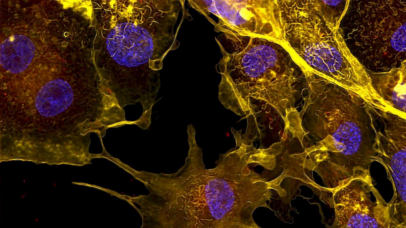 Rheumatoid Arthritis