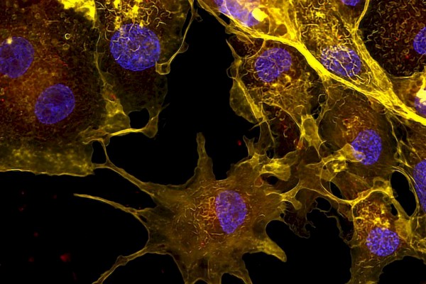 Rheumatoid Arthritis
