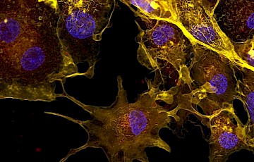 Rheumatoid Arthritis